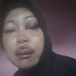 Begini Kondisi Terakhir Ibu di Bulukumba yang Dianiaya Debt Collector, Mata Terancam Tak Melihat